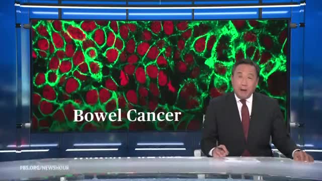 Immunotherapy offers new hope in bowel cancer fight