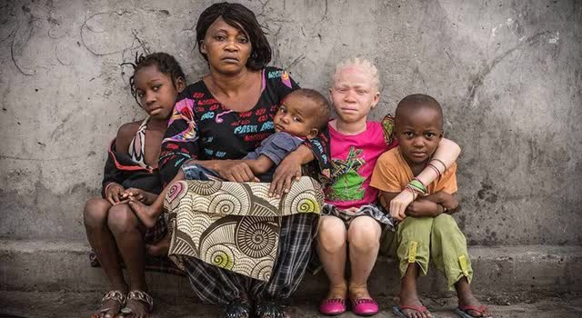 UN committee urges Tanzania to investigate attacks on people with albinism